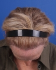 After Hair Transplant&nbsp;Hair Thinning